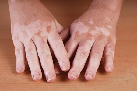 vitiligo