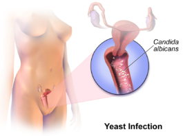 vajinal candidiasis