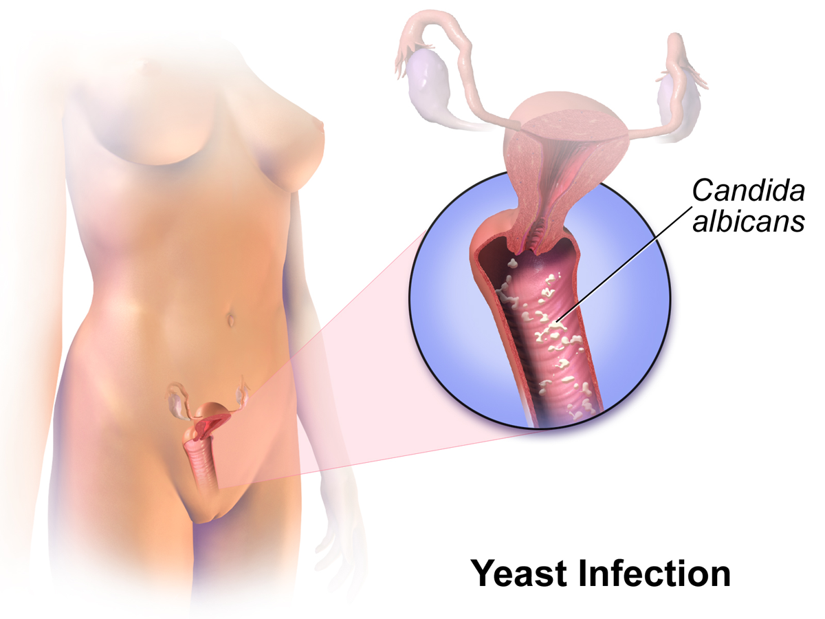 vajinal candidiasis